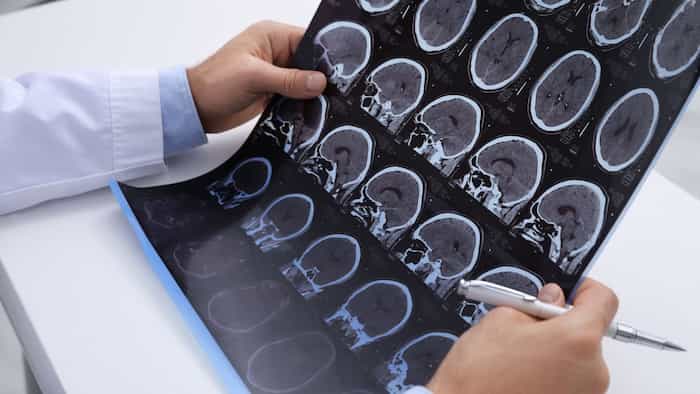 Intelligenza artificiale e neurologia: un esempio di neuroimaging